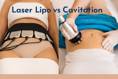 Laser Lipo vs Cavitation treatment comparison on abdomen.